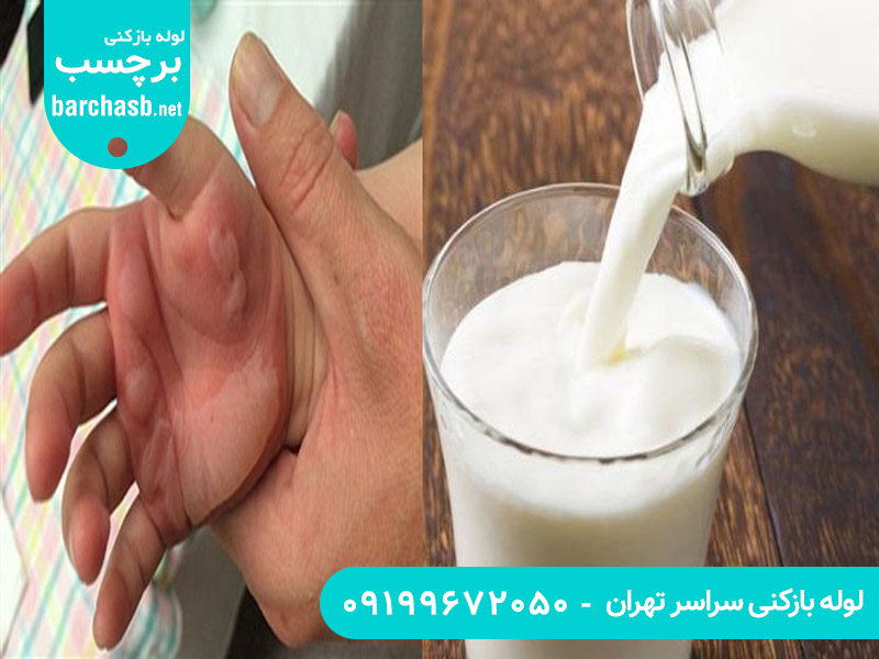 شیر برای درمان سوختگی با اسید لوله بازکنی